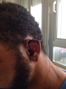 L'orecchio sinistro della vittima dopo l'aggressione